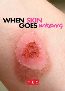 Pôster de When Skin Goes Wrong